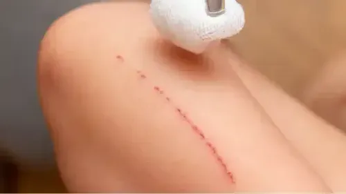 Scar Removal Cost in India: Treatments & Price Breakdown